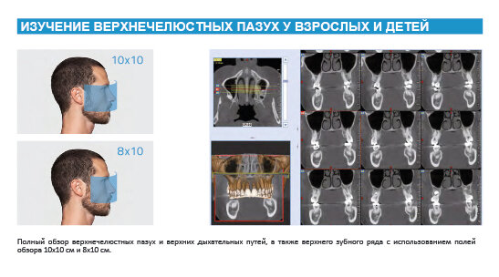 ИЗУЧЕНИЕ ВЕРХНЕЧЕЛЮСТНЫХ ПАЗУХ У ВЗРОСЛЫХ И ДЕТЕЙ